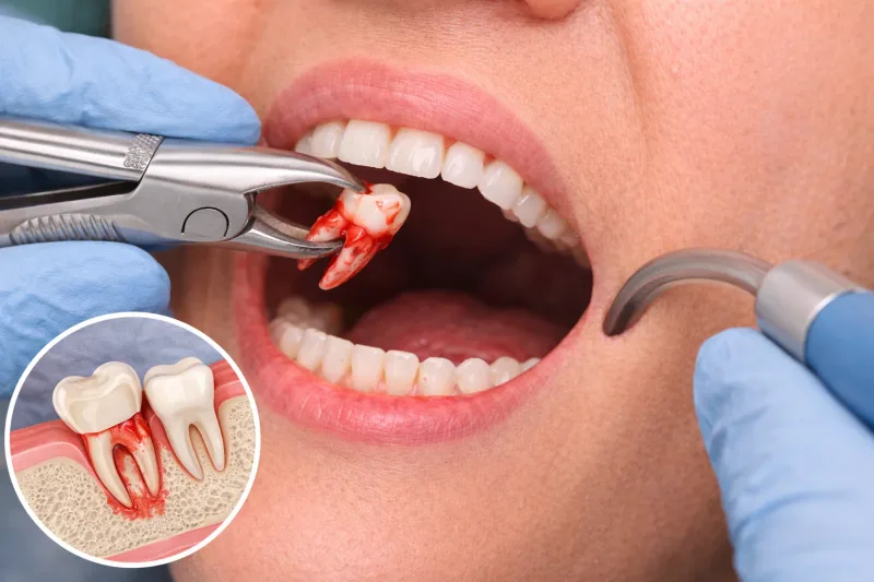 Wisdom tooth extraction consultation and planning